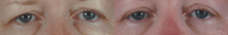 Patient 4 Blepharoplasty Before and After