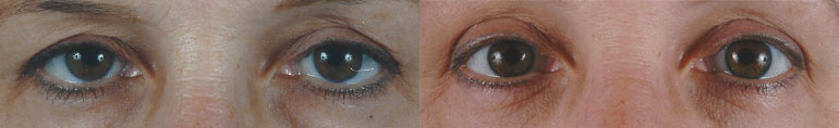 Patient 5 Blepharoplasty Before and After