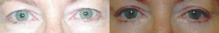 Patient 6a Blepharoplasty Before and After