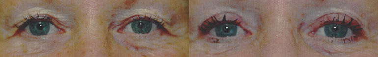 Patient 7a Blepharoplasty Before and After