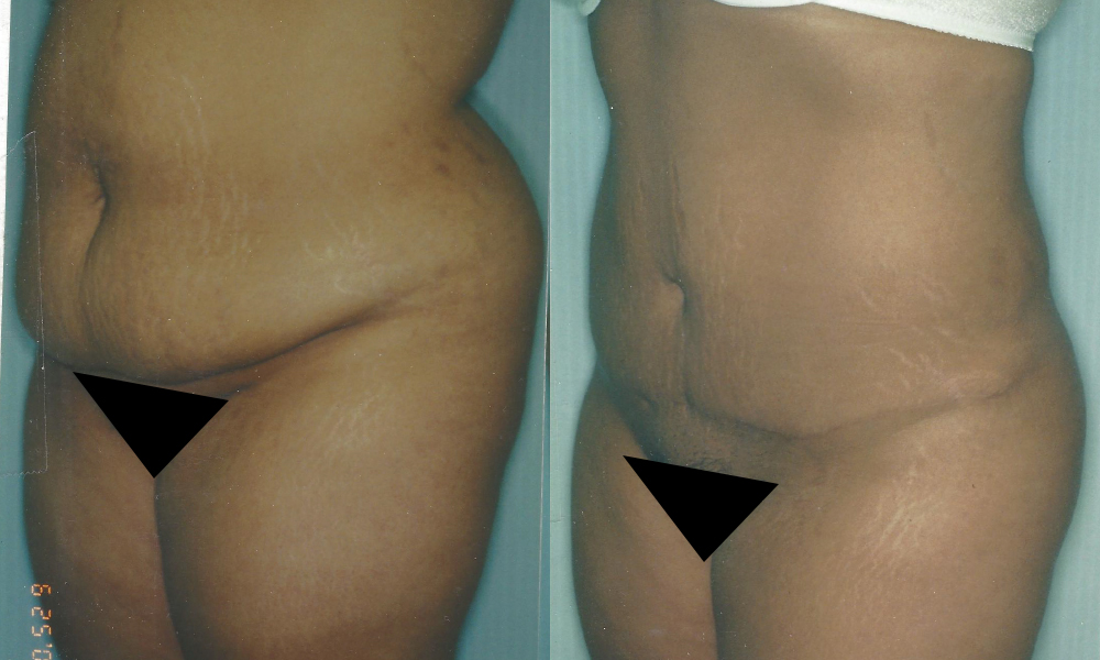 Patient 6a Liposuction Before and After