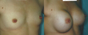 Patient 16a Breast Augmentation Before and After