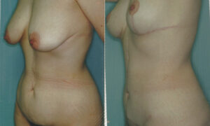 Patient 10b Tummy Tuck Before and After