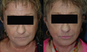 Patient 8a Facelift Before and After