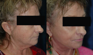 Patient 8b Facelift Before and After