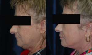 Patient 8c Facelift Before and After