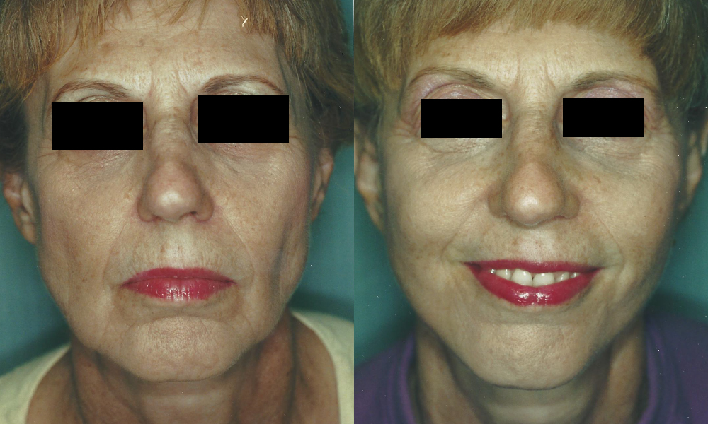 Patient 7a Facelift Before and After