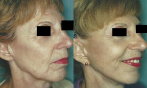 Patient 7b Facelift Before and After