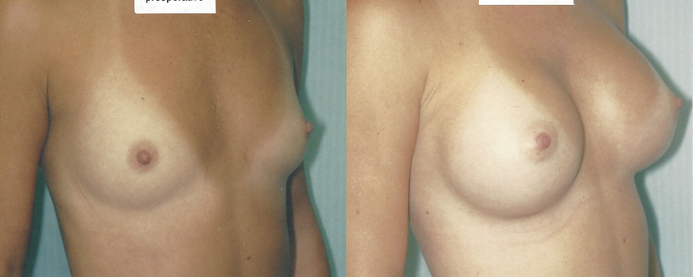 Patient 14a Breast Augmentation Before and After