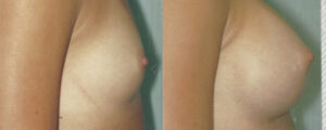 Patient 14b Breast Augmentation Before and After