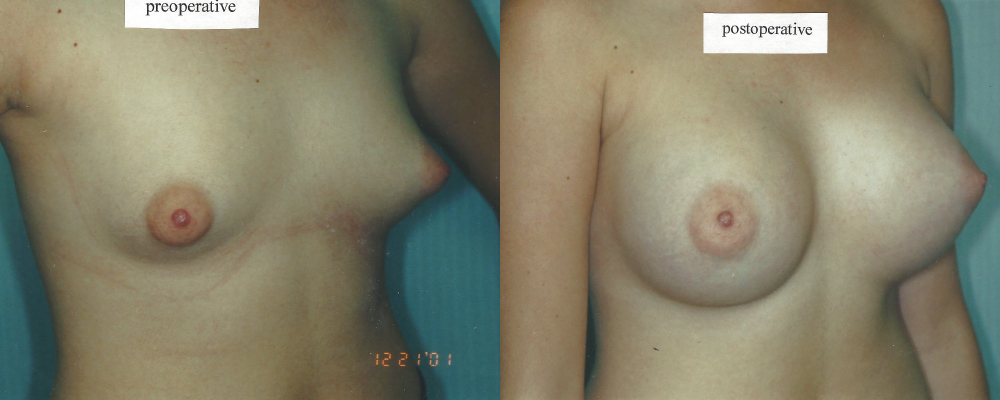 Patient 15 Breast Augmentation Before and After