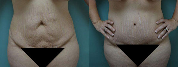 Patient 4 Tummy Tuck Before and After