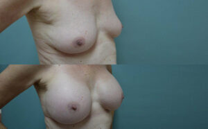 Patient 3e Breast Augmentation Before and After
