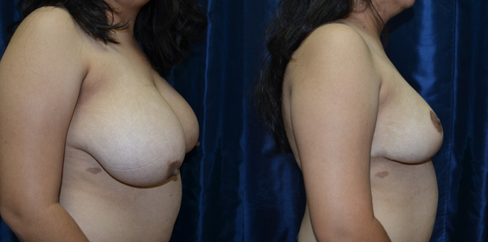 Patient 9a Breast Reduction Before and After