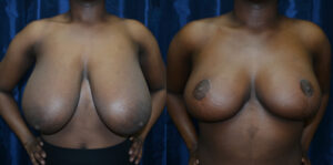 Patient 8a Breast Reduction Before and After