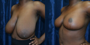 Patient 8c Breast Reduction Before and After