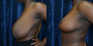 Patient 8d Breast Reduction Before and After