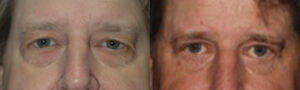 Patient 9a Blepharoplasty Before and After