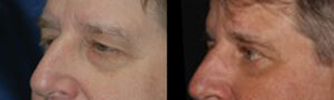 Patient 9b Blepharoplasty Before and After