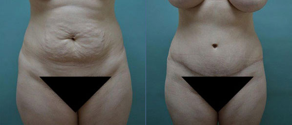 Patient 3 Tummy Tuck Before and After