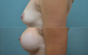 Patient 2b Breast Augmentation Before and After