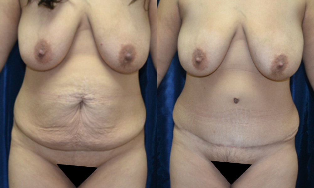 Patient 11a Tummy Tuck Before and After