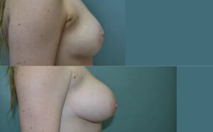 Patient 8c Breast Augmentation Before and After