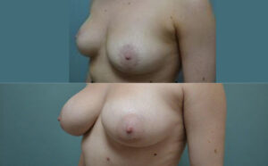 Patient 8d Breast Augmentation Before and After