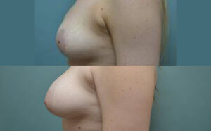 Patient 8e Breast Augmentation Before and After