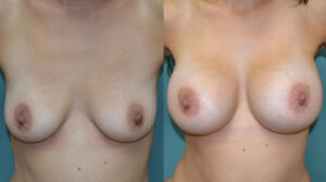 Patient 1a Breast Augmentation Before and After