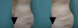 Patient B Tummy Tuck Before and After