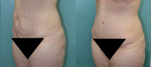 Patient B Tummy Tuck Before and After View 2