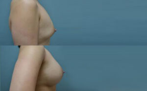 Patient 9c Breast Augmentation Before and After