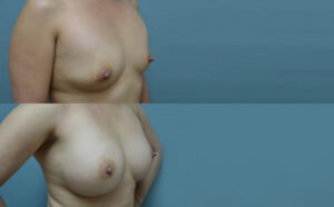 Patient 9d Breast Augmentation Before and After