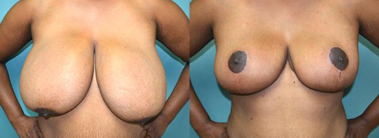 Patient 5a Breast Reduction Before and After