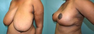 Patient 5b Breast Reduction Before and After