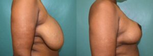 Patient 5d Breast Reduction Before and After