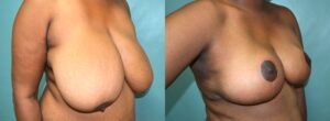 Patient 5e Breast Reduction Before and After