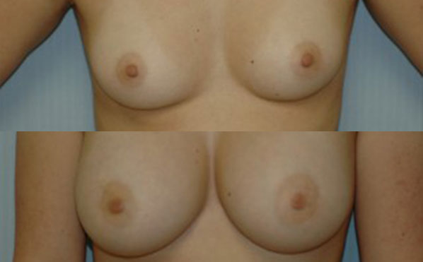 Patient 4 Breast Augmentation Before and After