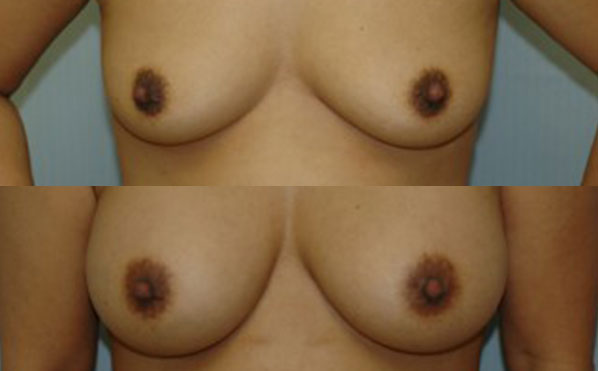 Patient 5 Breast Augmentation Before and After