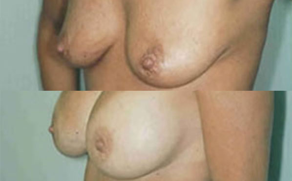 Patient 7 Breast Augmentation Before and After