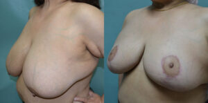 Patient 3a Breast Reduction Before and After