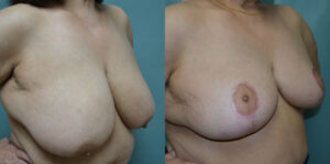 Patient 3b Breast Reduction Before and After