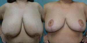 Patient 3c Breast Reduction Before and After