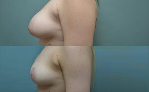 Patient 1c Breast Reduction Before and After