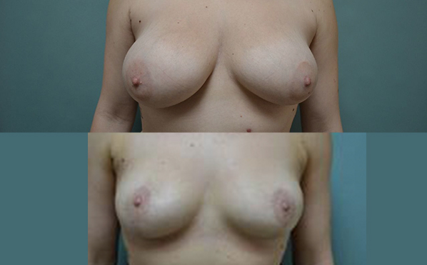 Patient 1a Breast Reduction Before and After