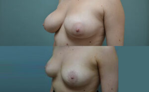 Patient 1e Breast Reduction Before and After