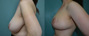 Patient 4e Breast Reduction Before and After