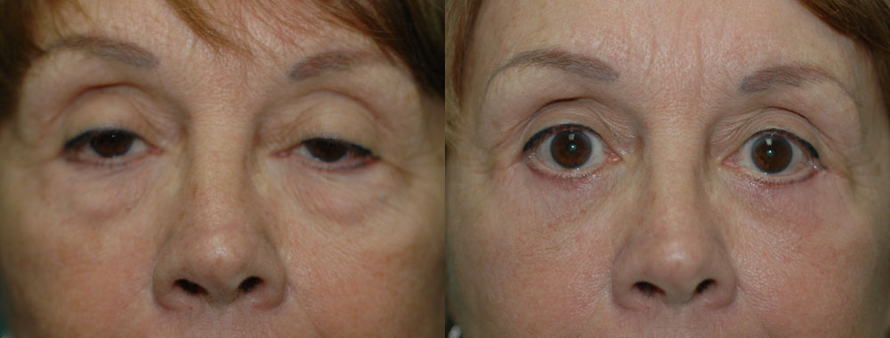 Patient 8a Blepharoplasty Before and After