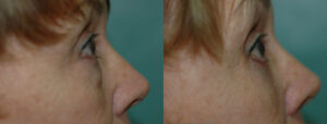 Patient 8e Blepharoplasty Before and After